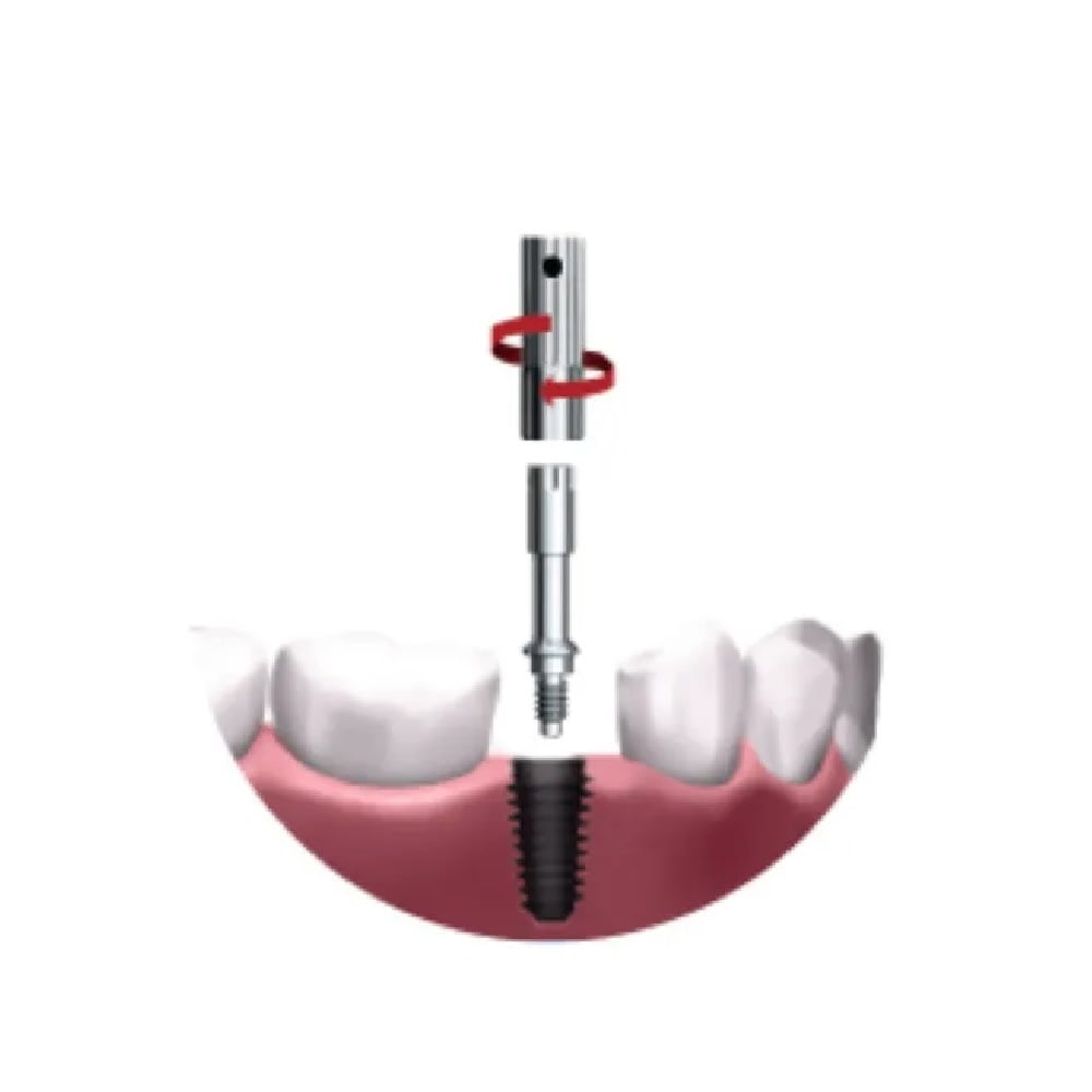 Multipeg Type 81 pour Osseo 100
