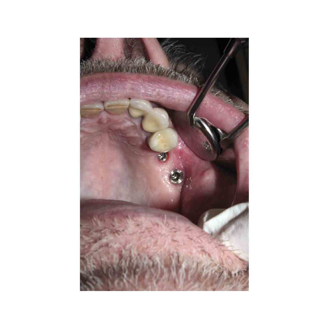 Cybertemp Long 1 smart mix + 5 embouts