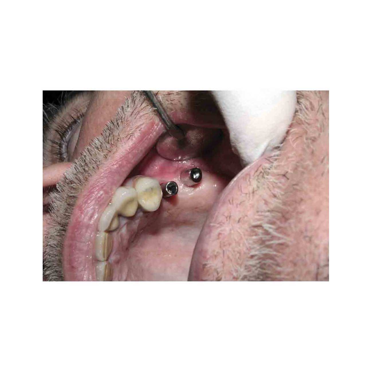 Cybertemp Long 1 smart mix + 5 embouts