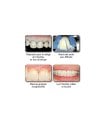 Miniature Nexus NX3 Dual cure - seringue automix 5g - blanc