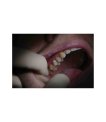 Miniature Provitemp automix ( seringue 5 ml + embouts)