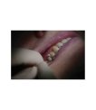 Miniature Provitemp automix ( seringue 5 ml + embouts)