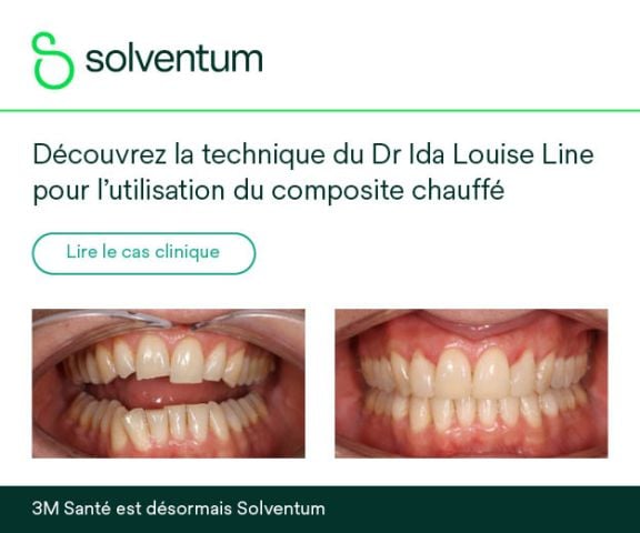 Intérêt du composite chauffé en pratique clinique : cas de restauration directe
