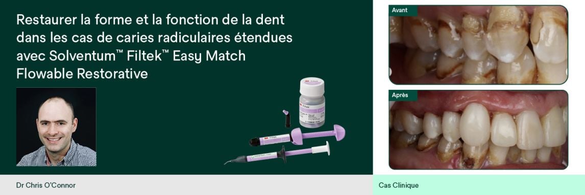 Restaurer la forme et la fonction de la dent dans les cas de caries radiculaires étendues avec Solventum™ Filtek™ Easy Match Flowable Restorative