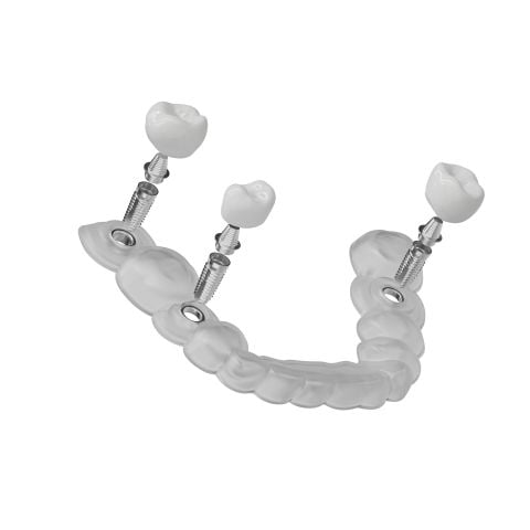 Guide chirurgical implantaire : précision et sécurité en implantologie