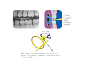 Angulateur Bite-Wings Senso Horizontal Pour Radiographie Interproximale (4)