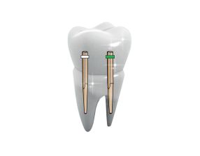 TENONS PEEK-OPTIMA