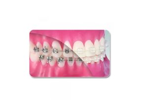 Arcs orthodontique NiTi - rectangle (10)