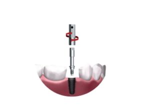 Multipeg Type 81 pour Osseo 100