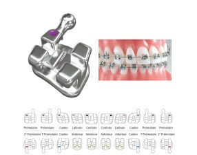 Brackets Votion Sans Torque Méthode MBT (Kit Patient)