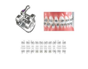 Brackets Pinnacle Avec Torque Méthode MBT (Kit Patient)