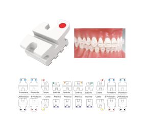 Brackets Reflection Méthode MBT (Kit Patient)